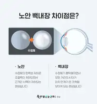 BGN 밝은눈안과 노안과 백내장 차이 설명 카드뉴스