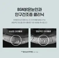 BGN 밝은눈안과 안구건조증 클리닉 마이봄샘 상태 비교 브랜드 콘텐츠