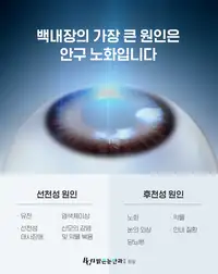 BGN 밝은눈안과 백내장 발생 원인 안내 브랜드 콘텐츠