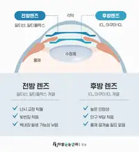 BGN 밝은눈안과 안내렌즈삽입술 전방·후방 렌즈 비교 카드뉴스