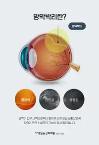 BGN 밝은눈안과 망막박리 원인 안과 정보 카드뉴스