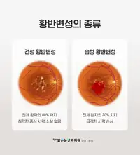 BGN 밝은눈안과 황반변성 종류 안과 정보 카드뉴스