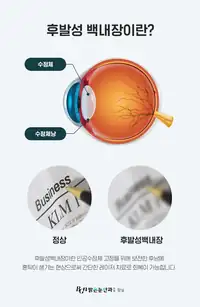 BGN 밝은눈안과 후발성 백내장 안과 정보 카드뉴스