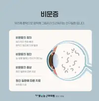 BGN 밝은눈안과 비문증 정의와 원인 안과 정보 카드뉴스