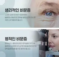 BGN 밝은눈안과 생리적 비문증과 병적 비문증 구분 카드뉴스