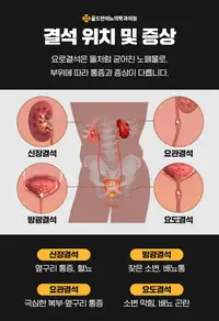 골드만비뇨의학과 요로결석 위치별 증상 안내 수술 브랜딩 콘텐츠