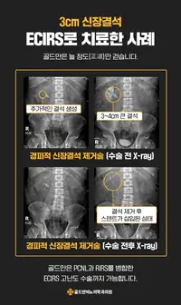 골드만비뇨의학과 신장결석 내시경 병합 수술 사례 수술 브랜딩 콘텐츠
