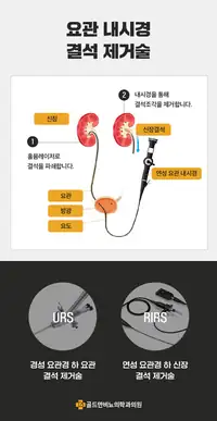 골드만비뇨의학과 요관 내시경 결석 제거술 안내 비뇨기질환 콘텐츠