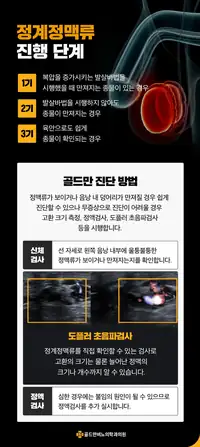 골드만비뇨의학과 정계정맥류 진행 단계와 진단 방법 안내 비뇨기질환 콘텐츠