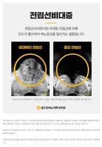 골드만비뇨의학과 전립선비대증 질환 설명 브랜드 블로그 콘텐츠