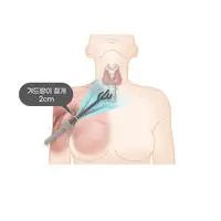 민병원 갑상선 겨드랑이 접근 수술 일러스트