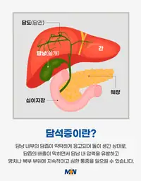 민병원 담석증 안내 정보 콘텐츠
