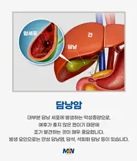 민병원 담낭암 안내 정보 콘텐츠