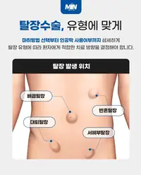 민병원 탈장 유형별 수술 안내 콘텐츠