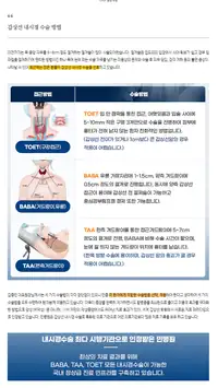 민병원 브랜드 블로그 포스트 — 갑상선 내시경수술 방법