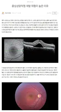새빛안과병원 중심성 장액맥락망막병증 안내 브랜드 블로그 콘텐츠