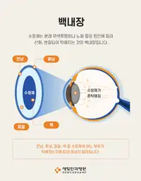 새빛안과병원 백내장 발생 원리 안내 SNS 카드뉴스