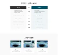 새빛안과병원 일반 라식과 스마일수술 비교 콘텐츠