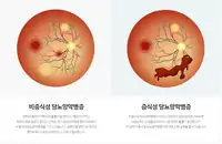 새빛안과병원 당뇨망막병증 단계 비교 일러스트