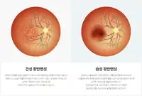 새빛안과병원 건성·습성 황반변성 비교 일러스트