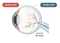 새빛안과병원 망막중심 동맥·정맥 구조 일러스트