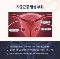 서울IVF여성의원 자궁근종 발생 부위 안내 콘텐츠